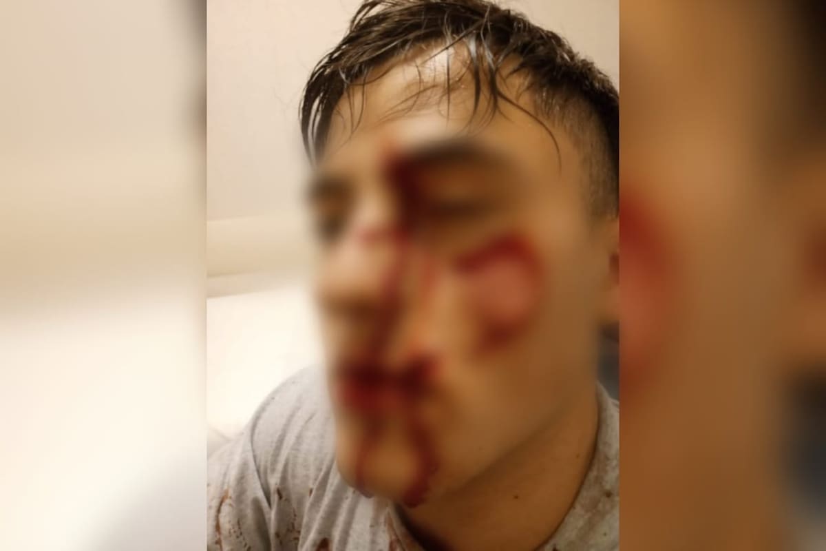 Nicolás perdió la visión del ojo izquierdo tras el ataque con la copa rota