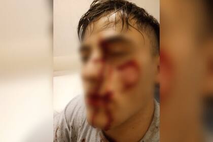 Nicolás perdió la visión del ojo izquierdo tras el ataque con la copa rota