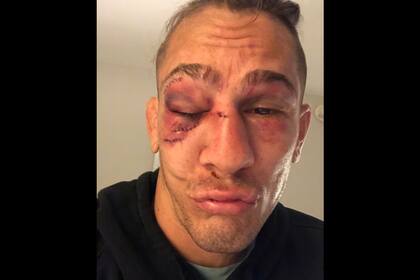 Niko Price se tomó una selfi y la publicó hoy en su Instagram para mostrar su rostro y las costuras que le aplicaron los médicos.