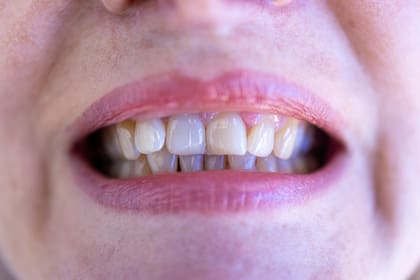 No es raro que los dientes se desplacen con la edad y suele ocurrir más en los dientes inferiores que en los superiores