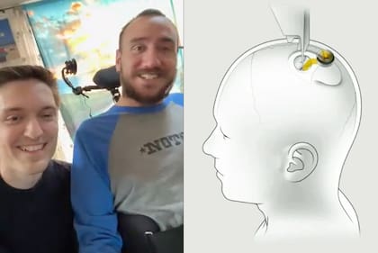 Nolan Arbaugh es cuadripléjico y es la primera persona en tener un chip Neuralink instalado en el cerebro; le permite interactuar con una computadora usando la mente
