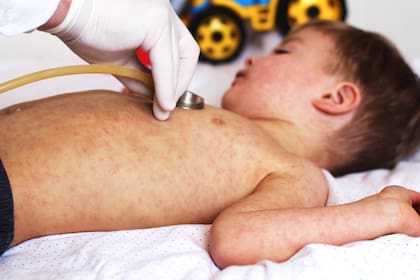 El sarampión afecta principalmente a los niños, pero también se desarrolla en adultos
