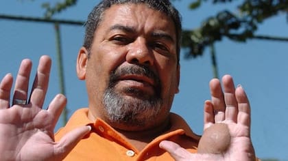 Odesson Ferreira, con la marca del Cesio 137 en sus manos