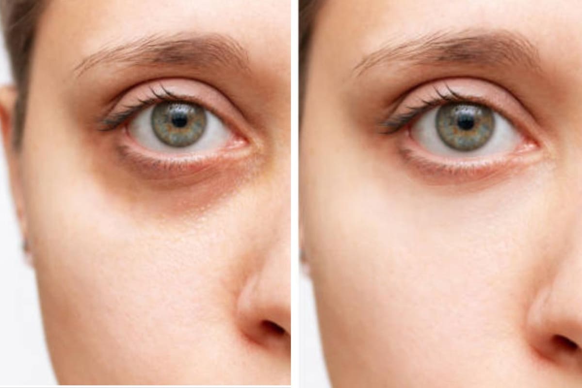 Ojeras: ese tono azulado, grisáceo o morado es una característica bastante común en muchas personas (Foto: iStock)