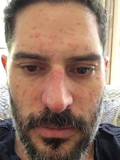 Otra de las imágenes que el actor compartió en sus redes, en este caso, para mostrar las lesiones cutáneas que le provocó su extraña enfermedad
