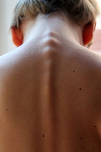 Otra de las medidas para evitar el dolor de espaldas es implementar compresas frías y calientes en las zonas donde haya dolor lumbar