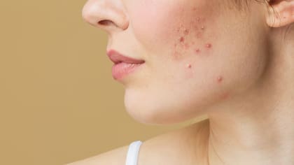 Otros signos de colesterol elevado pueden incluir urticaria, irritación en la piel, granos similares al acné, sensación de picor y manchas rojizas
