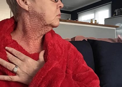 Pagó más de 600 dólares por un tratamiento con plasma de fibroblastos (Crédito: The Sun)