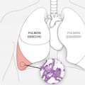 Qué es un adenocarcinoma pulmonar, cómo se trata y qué pronóstico tiene