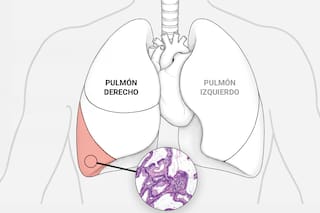 Qué es un adenocarcinoma pulmonar, cómo se trata y qué pronóstico tiene
