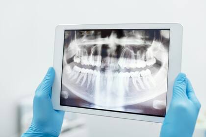 Para prevenir la periodontitis, se recomienda: cepillarse los dientes, usar hilo dental, realizar limpiezas profesionales cada seis meses (imagen ilustrativa)
