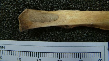 Parche elevado de hueso más oscuro y poroso en una costilla. "Este es hueso nuevo reactivo que se produce en respuesta a inflamación y nos dice que el revestimiento alrededor de los pulmones estaba inflamado en el momento de la muerte", señaló Gowland.