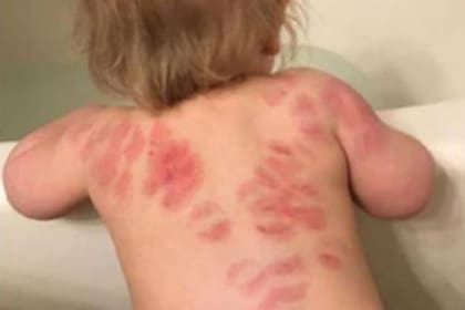 Parte de las marcas que tenía la pequeña Rosalyn