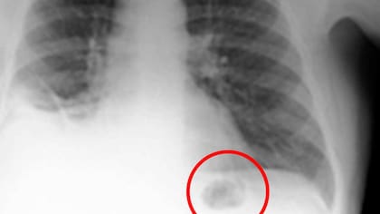 Pensaron que era cáncer y era un cono de PlayMobil