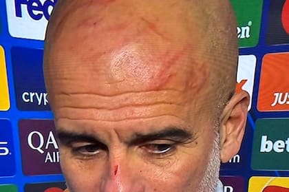 Pep Guardiola, con los arañazos que se infligió en la cabeza y el rostro luego de que Feyenoord igualara 3-3 un partido que Manchester City ganaba por 3-0