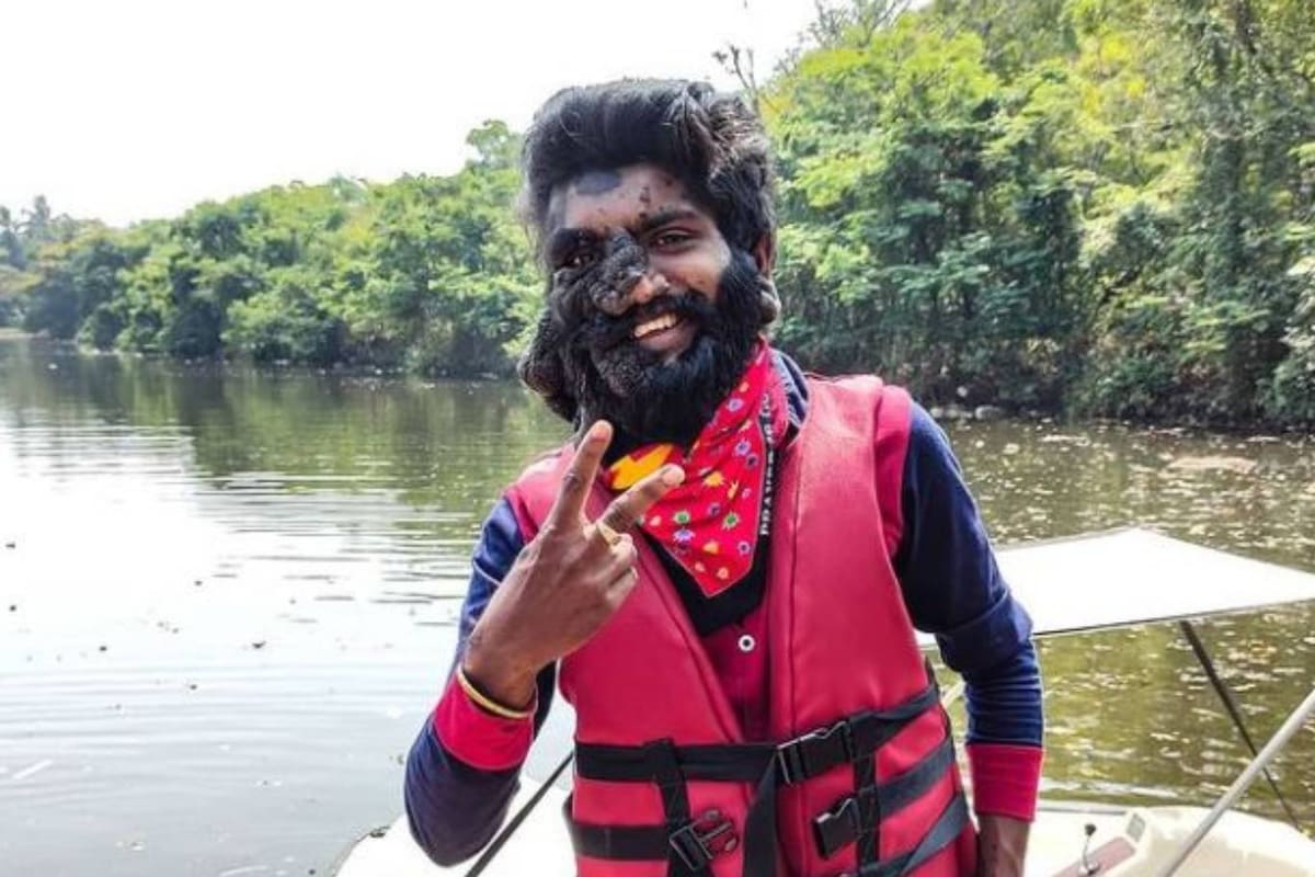Prabhulal Prasannan es un joven indio que nació con gran parte de su rostro cubierta por enormes lunares y sufrió todo tipo de burlas desde niño