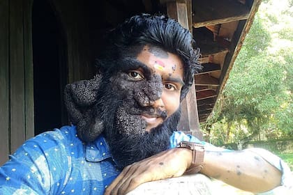 Prabhulal Prasannan tiene el 80 por ciento de su rostro cubierto de lunares