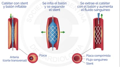El procedimiento de una angioplastía coronaria con aplicación de stent.