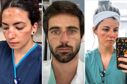 Profesionales de la salud de todo el mundo comparten imágenes en redes sociales de sus rostros gravemente afectados por el uso de máscaras y barbijos durante largas jornadas