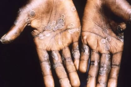 Pústulas características de la viruela del mono en paciente en la República Democrática del Congo