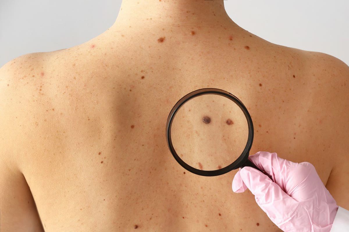 Qué es la cirugía de MOHS, la técnica para tratar el cáncer de piel