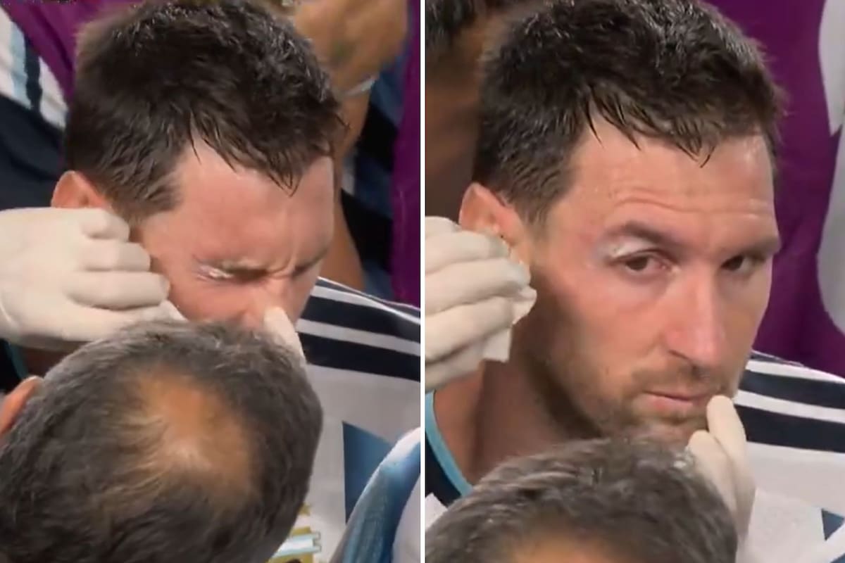 Qué le pasó en el ojo a Lionel Messi: terminó el partido con sangre
