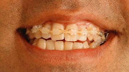 ¿Qué pasa cuando te sacan los brackets?