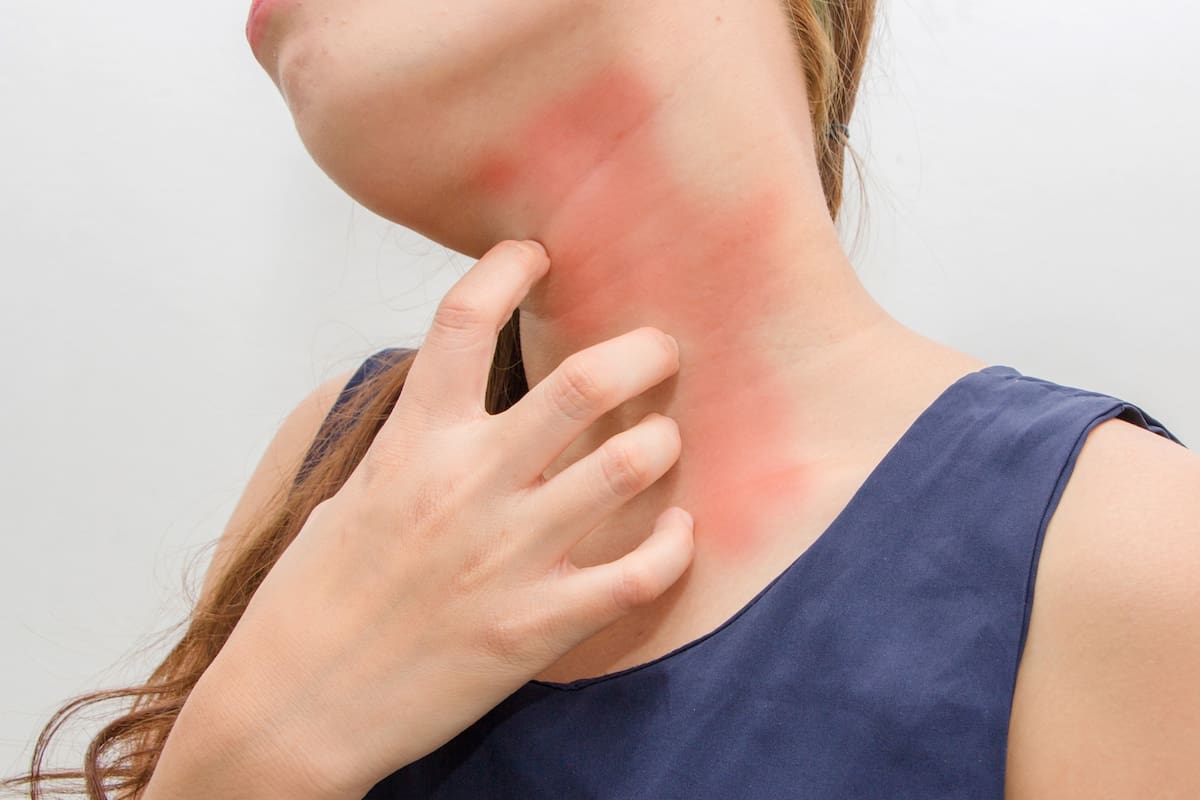 Qué son las alergias medicamentosas