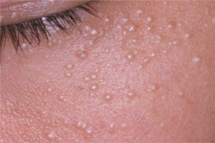 Qué son los quistes de millium