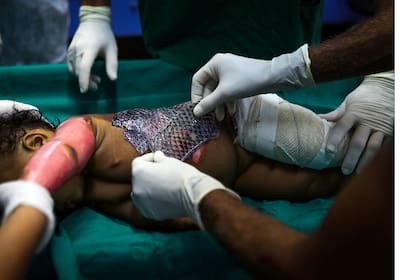 Doctores envuelven la piel quemada de un niño con piel de tilapia esterilizada en el Instituto Dr. José Frota en la ciudad costera de Fortaleza, Brasil