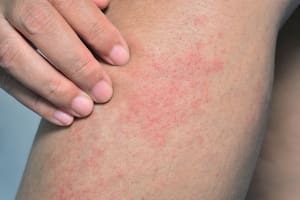 rash on the woman leg skin
