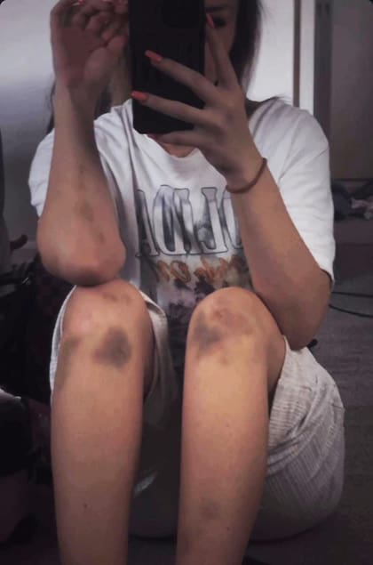 Rebecca mostró a la BBC fotos de sus hematomas.