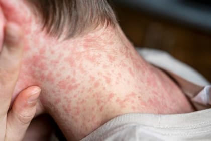 Reiteraron la importancia de que la población esté atenta a la aparición de fiebre alta, manchas rojas en la piel, secreción nasal, conjuntivitis y tos