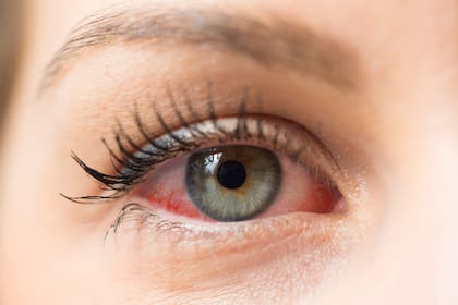 Remedios para aliviar los ojos rojos: por qué se ponen así y cómo tratarlo