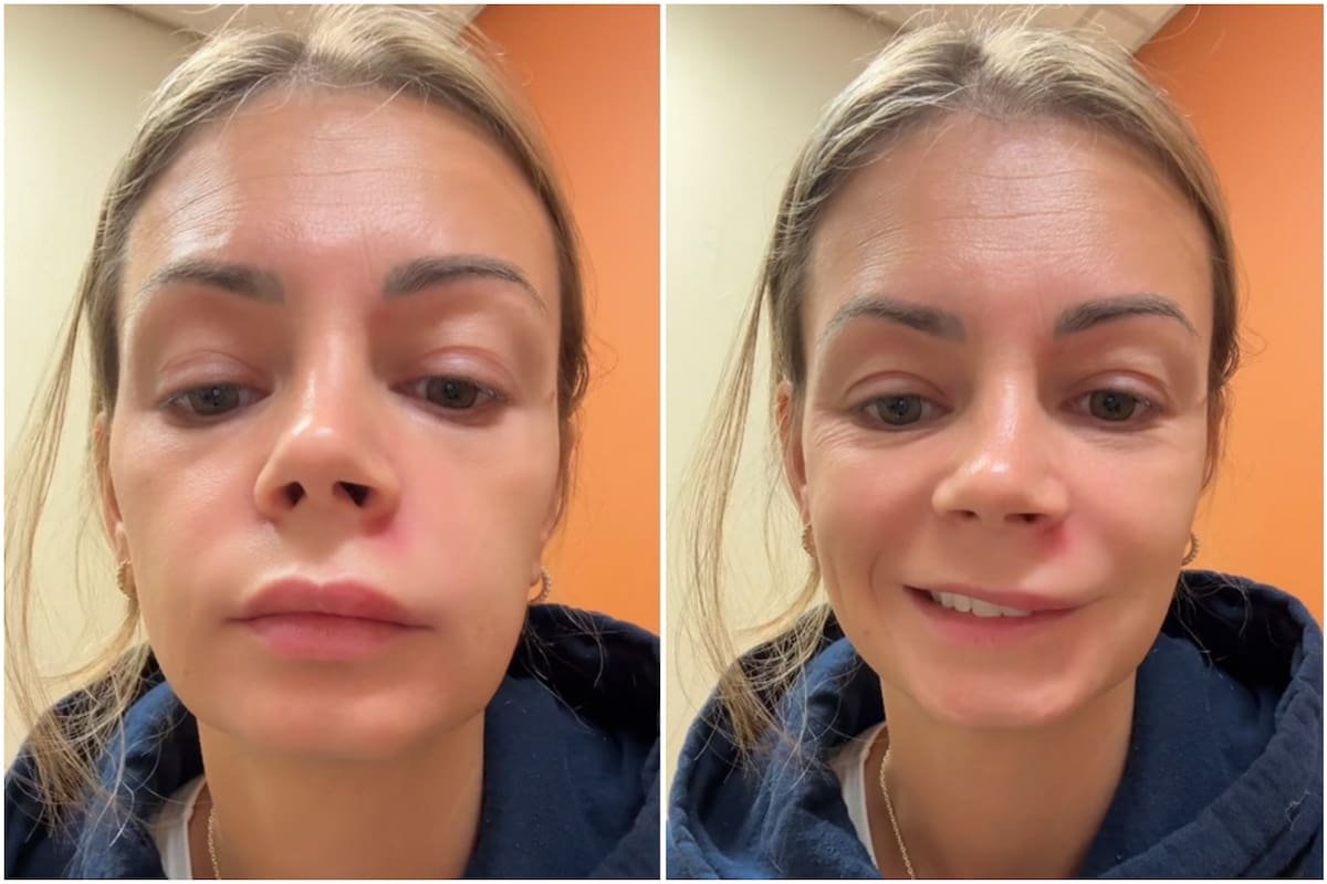 Reventarse un grano en el “triángulo de la muerte” puede provocar complicaciones graves, advirtió una especialista