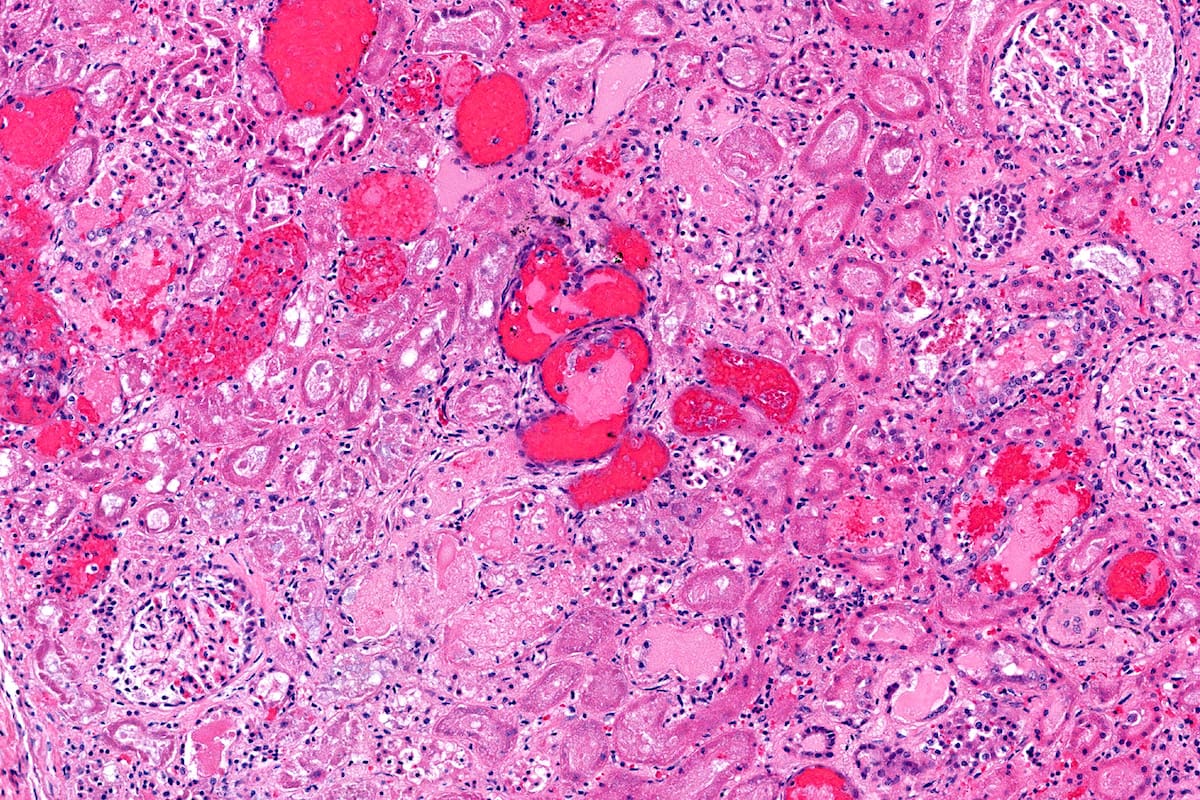 Riñón de un paciente con síndrome urémico hemolítico por E. coli