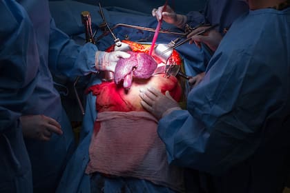 Sacan el hígado enfermo. Es fibroso, con nódulos y de un tono morado. El cuerpo pasa a la etapa anhepática.