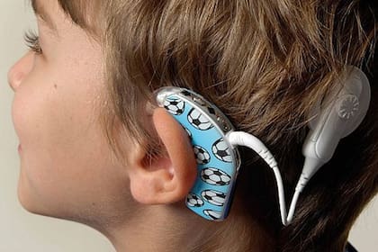 Hasta un 80% de los niños hipoacúsicos pueden recuperar su audición con un implante coclear