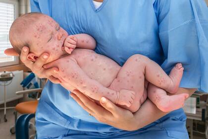 Sarampión: advierten que la situación en la región "es complicada" por el brote en Venezuela