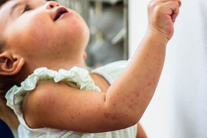 Iniciaron una investigación para identificar la fuente del contagio de la beba de ocho meses que fue diagnosticada con ese virus