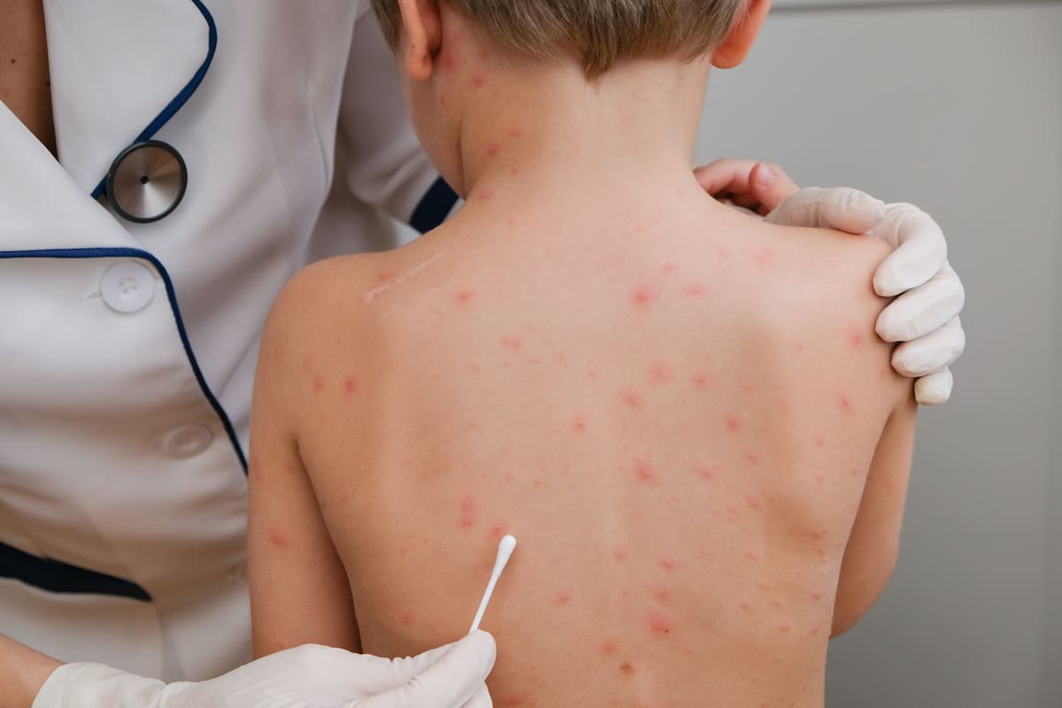 Sarampión, la infección viral más contagiosa