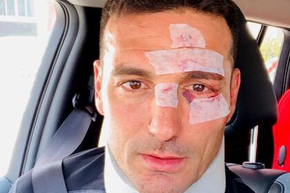 Scaloni al ser dado de alta