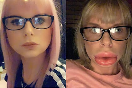 Se aplicó inyecciones en los labios pero el resultado no fue el esperado