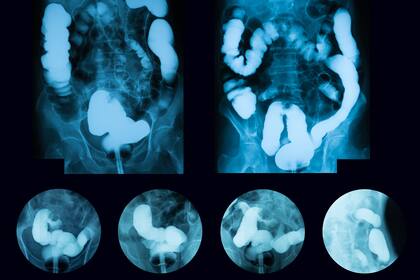 Se calcula que más de 44.000 personas serán diagnosticadas con cáncer de colon este año