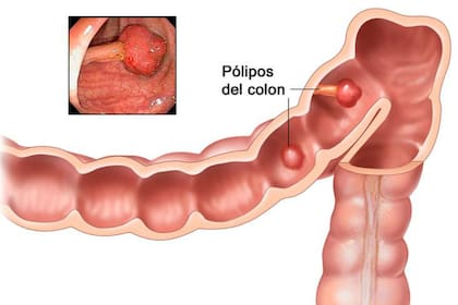 Durante una colonoscopía se pueden detectar pólipos precancerosos y extirparlos