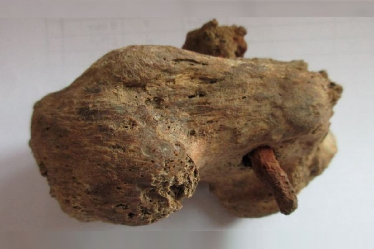 Se encontró un clavo incrustado en el tobillo del hombre