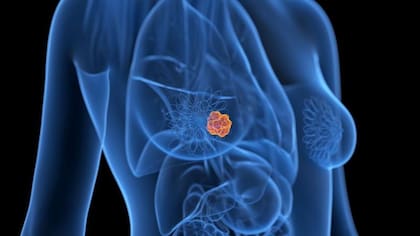 Se estima que en el país se detectan poco más de 20.000 casos nuevos de cáncer de mama anualmente