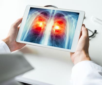 Se indican tomografías computadas a pacientes con antecedentes significativos de tabaquismo