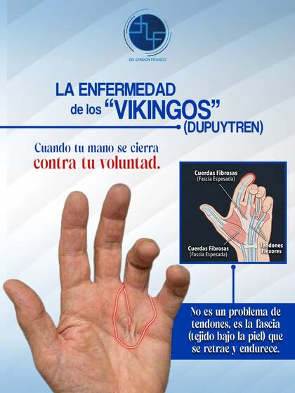 Se le llama "enfermedad de los vikingos" por su alta prevalencia en descendientes del norte de Europa