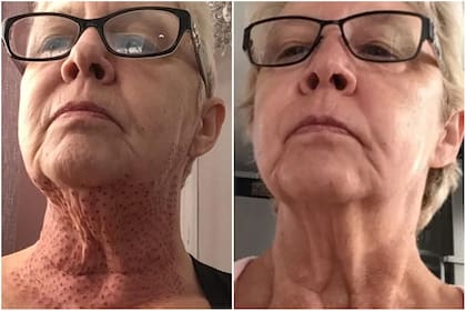 Se sometió a un tratamiento estético y terminó con cientos de cicatrices rojas en la piel (Crédito: The Sun)